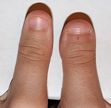 220px-Clubbed_thumb.jpg