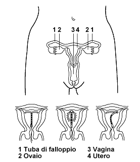 iud.gif